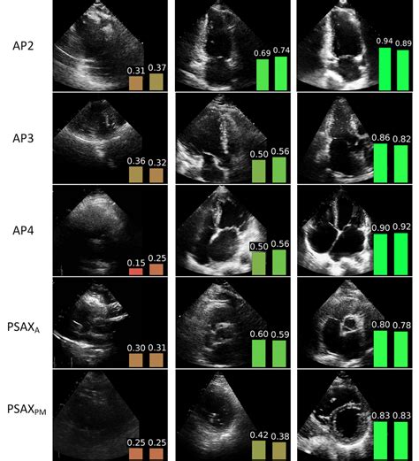 2d echo result sample|All You Need to Know: How to Read the 2D Echo Test Result.
